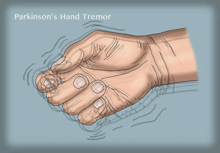 Framed Print : Illustration of a hand tremor, one of the symptoms of Parkinson's disease Framed Print : Illustration of a hand tremor, one of the symptoms of Parkinson's disease