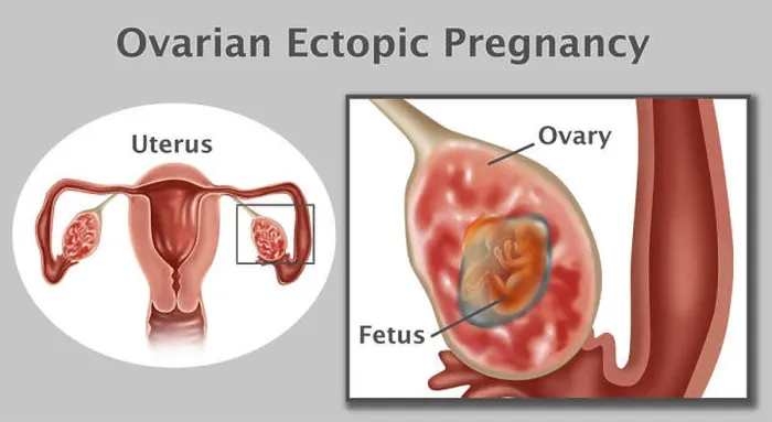 Framed Print : Illustration of an ovarian pregnancy Framed Print : Illustration of an ovarian pregnancy