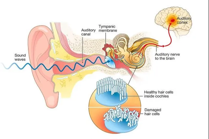 Framed Print : Illustration showing tinnitus. Damaged hair cells inside cochlea, labeled Framed Print : Illustration showing tinnitus. Damaged hair cells inside cochlea, labeled