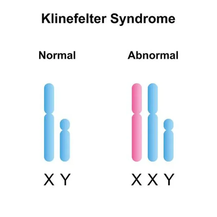 Framed Print : Klinefelter syndrome, illustration Framed Print : Klinefelter syndrome, illustration