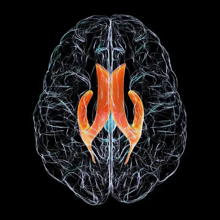 Framed Print : Lateral brain ventricles, illustration Framed Print : Lateral brain ventricles, illustration
