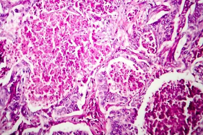 Framed Print : Lung adenocarcinoma, light micrograph, photo under microscope Framed Print : Lung adenocarcinoma, light micrograph, photo under microscope
