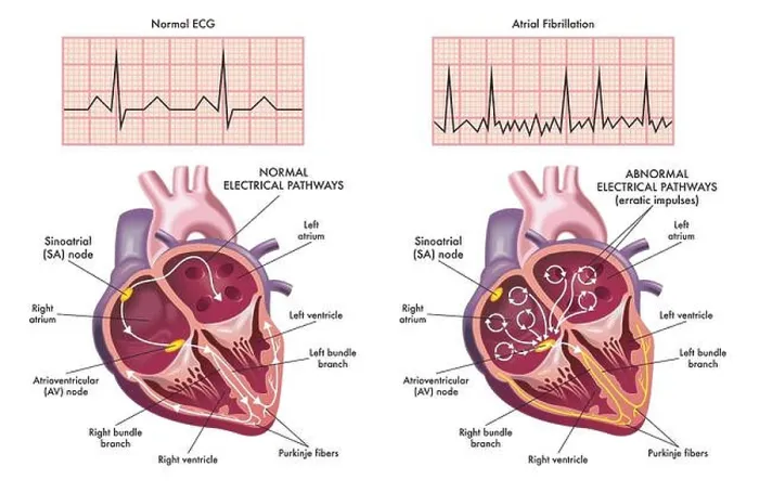 Framed Print : Medical illustration showing the symptoms of a heart with atrial fibrillation compared to normal one Framed Print : Medical illustration showing the symptoms of a heart with atrial fibrillation compared to normal one