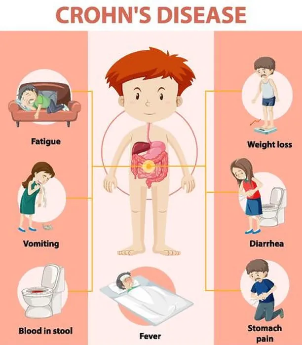 Framed Print : Medical infographic of Crohn's Disease illustration Framed Print : Medical infographic of Crohn's Disease illustration