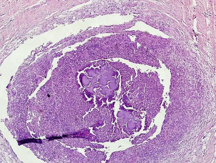 Framed Print : Microscopic image of Mycetoma. Mycetoma is a disease that is usually acquired through work in agriculture and generally affects men who contract Framed Print : Microscopic image of Mycetoma. Mycetoma is a disease that is usually acquired through work in agriculture and generally affects men who contract