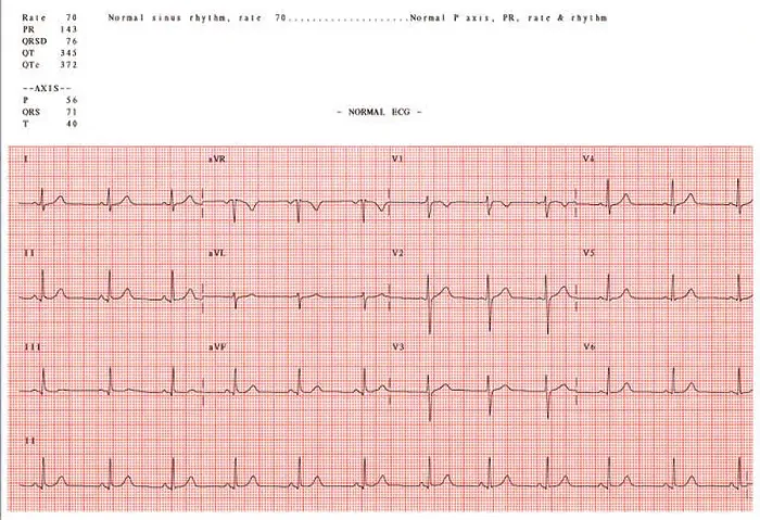 Framed Print : Normal electrocardiogram Framed Print : Normal electrocardiogram
