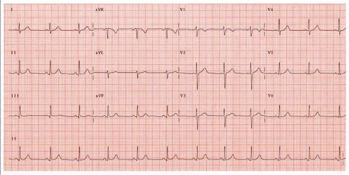 Framed Print : Normal electrocardiogram Framed Print : Normal electrocardiogram