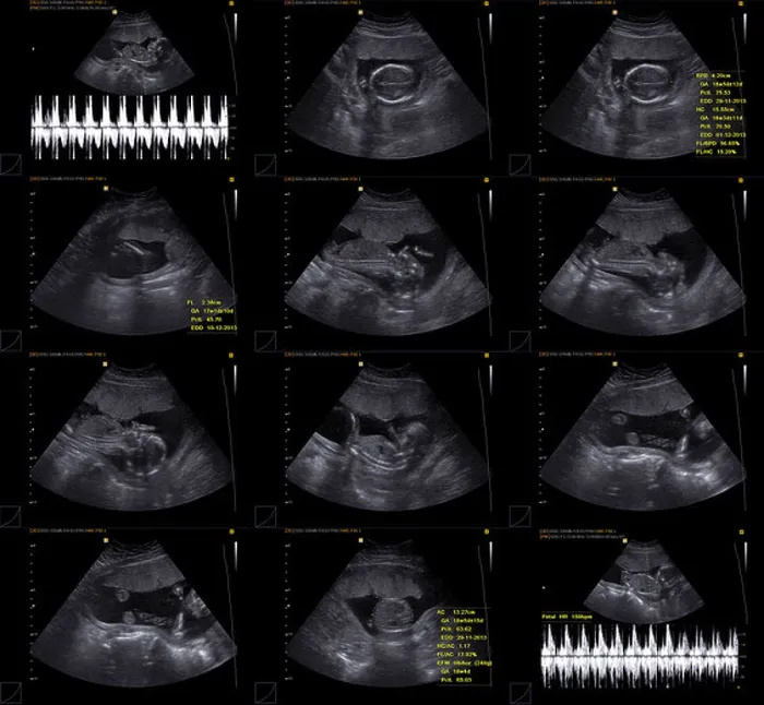 Framed Print : Normal obstetrical ultrasound including Döppler Framed Print : Normal obstetrical ultrasound including Döppler