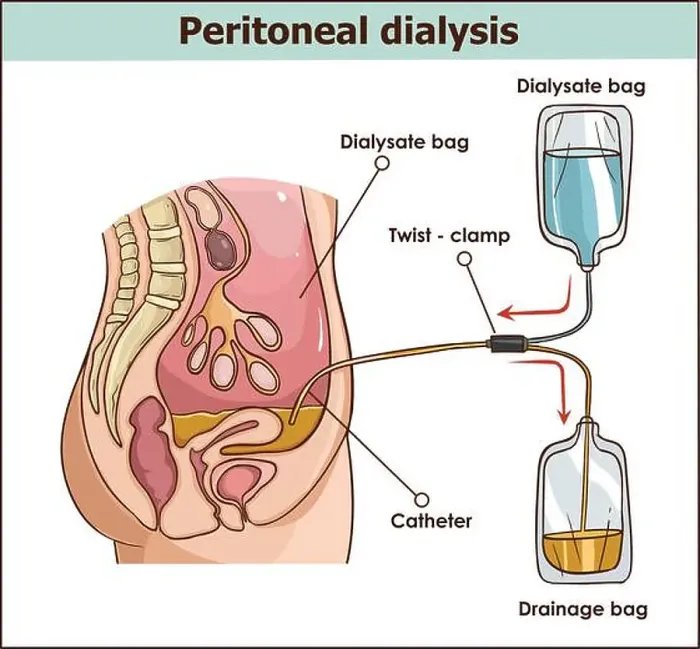 Framed Print : peritoneal dialysis are both used to treat kidney - vector illustration Framed Print : peritoneal dialysis are both used to treat kidney - vector illustration