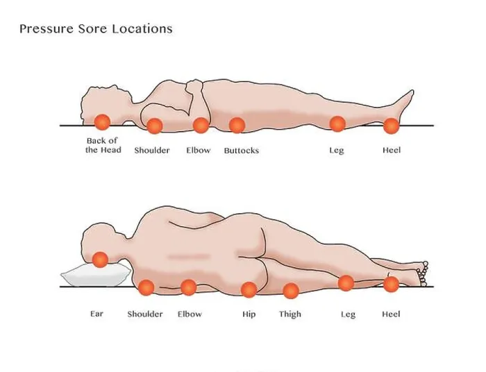 Framed Print : Pressure Sore Locations, Diagram Framed Print : Pressure Sore Locations, Diagram