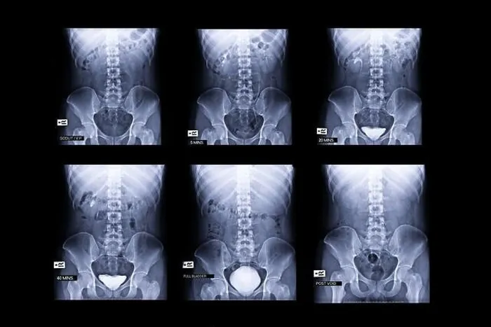 Framed Print : procedure of Intravenous pyelogram or I.V.P is an X-ray exam of urinary tract after injection contrast media agent 5, 20, 40 minute, Fullbladder Framed Print : procedure of Intravenous pyelogram or I.V.P is an X-ray exam of urinary tract after injection contrast media agent 5, 20, 40 minute, Fullbladder