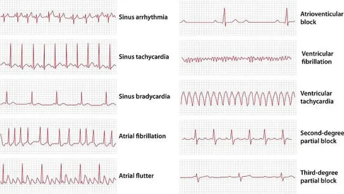 Framed Print : Schemes set of common electrocardiogram (ECG) abnormalities, including partial blocks and flutter Framed Print : Schemes set of common electrocardiogram (ECG) abnormalities, including partial blocks and flutter