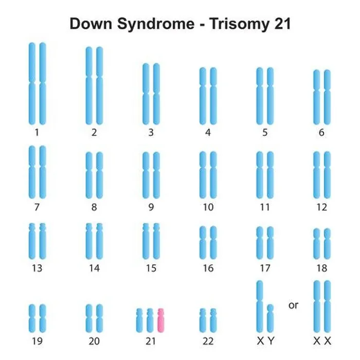 Framed Print : Scientific Designing of Down Syndrome (Trisomy 21) Karyotype. Colorful Symbols. Vector Illustration Framed Print : Scientific Designing of Down Syndrome (Trisomy 21) Karyotype. Colorful Symbols. Vector Illustration