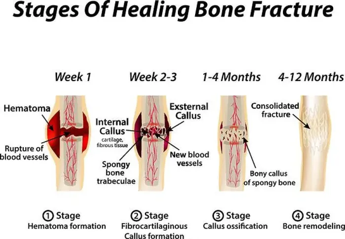 Framed Print : Stages Of Healing Bone Fracture Framed Print : Stages Of Healing Bone Fracture