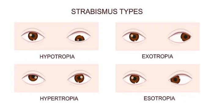 Framed Print : Strabismus types. Hypotropia, hypertropia Framed Print : Strabismus types. Hypotropia, hypertropia