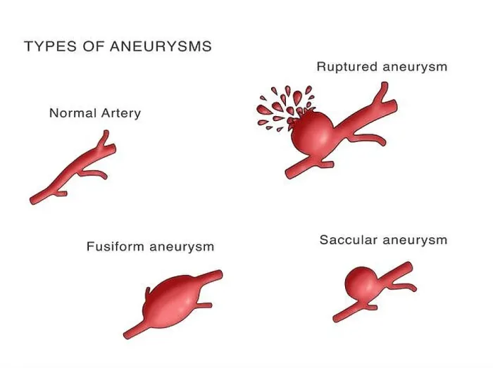 Framed Print : Types of Aneurysms Framed Print : Types of Aneurysms