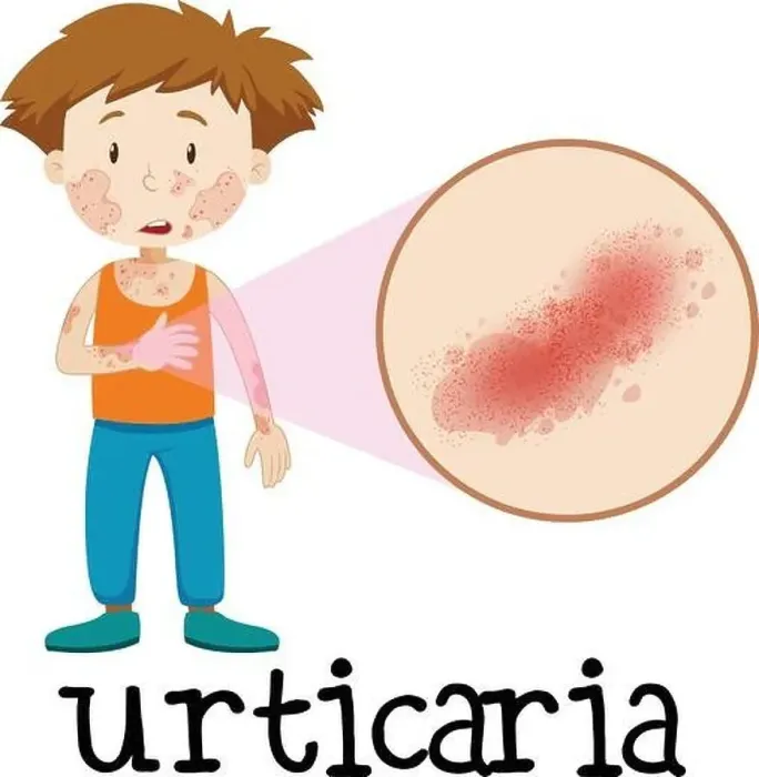 Framed Print : A Vector of Skin Urticaria illustration Framed Print : A Vector of Skin Urticaria illustration