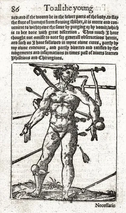 Framed Print : Wound-man illustration, 16th century, William Clowes Framed Print : Wound-man illustration, 16th century, William Clowes