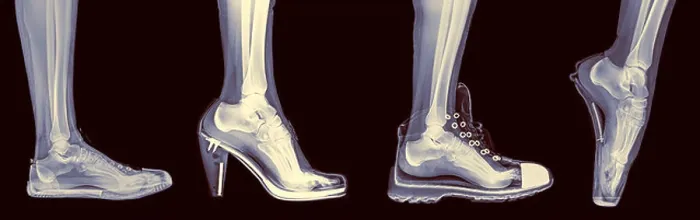 Framed Print : X-ray of a woman's foot in 4 different shoes (from left to right) Trainers, High Heel, Running and Ballet Framed Print : X-ray of a woman's foot in 4 different shoes (from left to right) Trainers, High Heel, Running and Ballet