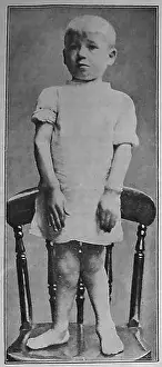 Lack Prints: A 1920 illustration of a child with rickets showing symptoms of deformed legs and thickened wrists and ankles