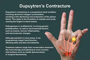 Disorder Prints: A 3D medical illustration displaying a patient's hand with Dupuytren's contracture