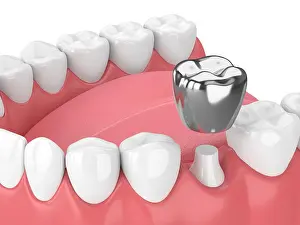 Dentistry Prints: 3d render of teeth with dental crown amalgam fillingover white background