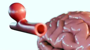 Nervous Prints: 3D rendering of a saccular 'berry' aneurysm