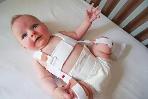 Diaper Prints: 4 month old baby with hip dysplasia being treated with a Pavlik harness