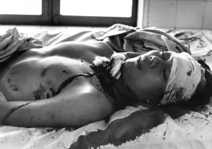Refugee Prints: One of 48 persons wounded by a Viet Cong explosion which killed 14 persons in Saigon awaits treatment in the Cong Hoa