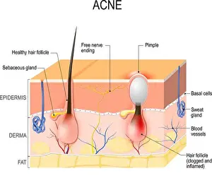 Inflamed Prints: Acne vulgaris or pimple. healthy hair follicle and clogged pore