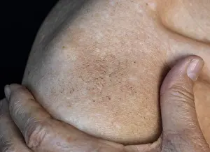 Discolored Prints: Age spots on body of Asian elder man