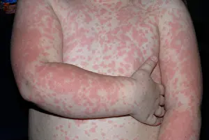 Rash Prints: Amoxicillin drug rash on young girl