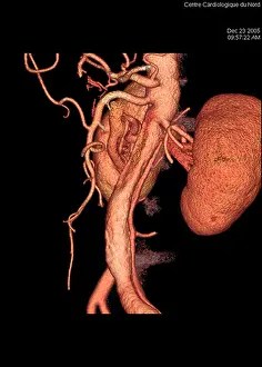 Examine Prints: ANEURYSM OF THE AORTA, 3D SCAN