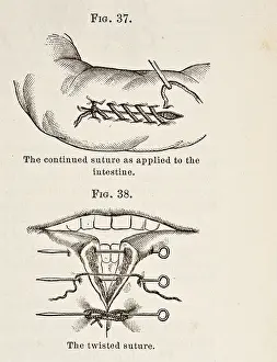 Wound Prints: Antique Illustration of Sutures circa 1881