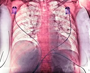 Aspiration. Coloured chest X-ray showing aspiration (dark areas)