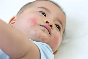 Sensitive Prints: Baby has an allergic reaction to the face, Skin rashes in babies concept