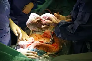 Sony Prints: Baby being born by Caesarean section in hospital