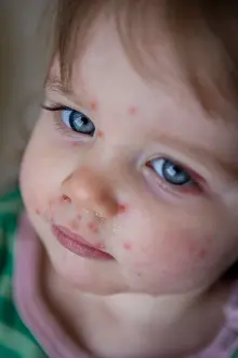 Rash Prints: A baby with chickenpox