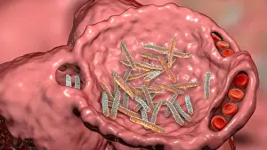Digitally Prints: Bacterial pneumonia. Computer illustration of rod-shaped bacteria (bacilli) inside the alveoli of the lungs