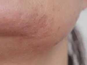 Rash Prints: bad skin close-up