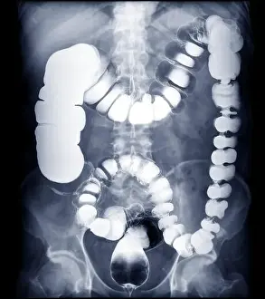 Wound Prints: BE or barium enema image or x-ray image of large intestine showing anatomical of colon for detect Colon cancer
