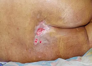 Wound Prints: bedsore, pressure sore