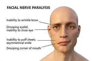 Paralysis Prints: Bell's palsy, a unilateral facial paralysis