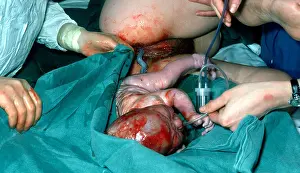 Obstetrics Prints: Birth vaginal delivery