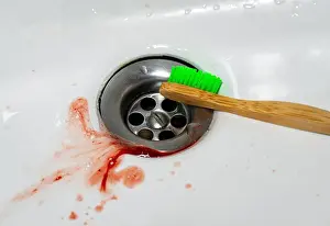 Dentistry Prints: Bleeding Gums While Brushing Teeth, Toothbrush and Blood in Bathroom Sink