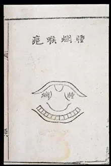 Pathology Prints: C18 Chinese woodcut: Swollen-putrid throat abscess