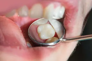 Dentistry Prints: caries spoiled tooth closeup photographed through dental mirror
