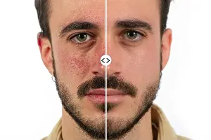 Cheek Prints: Caucasian male face with red skin rosacea before and after couperose treatment