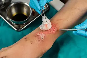 Ankle Prints: close up doctor cleaning wound on the leg, Injuries from falling