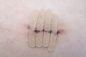 Wound Prints: close-up of human skin with suture and wound closure strips or surgical tape after mole or melanoma biopsy